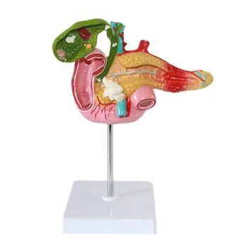1:1 Gyvenimo Dydis Dvylikapirštės Žarnos, Kasos, Tulžies Pūslės Patologijos Anatomijos Modelis Tulžies Akmuo Chirurgijos Virškinimo Sistemos Splenic Modelis